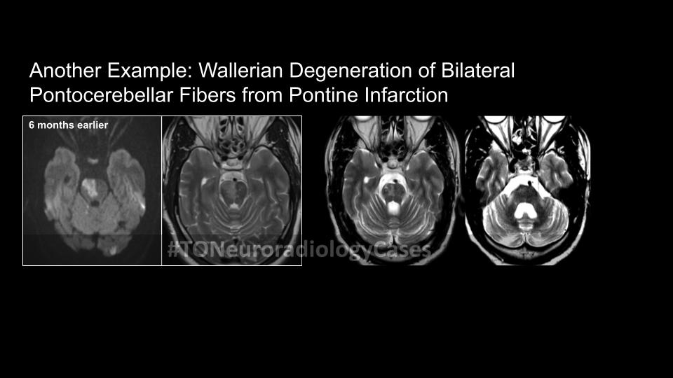Neuroradiology Case of the Week: Week 18 4 57M-prior-pontine ans3