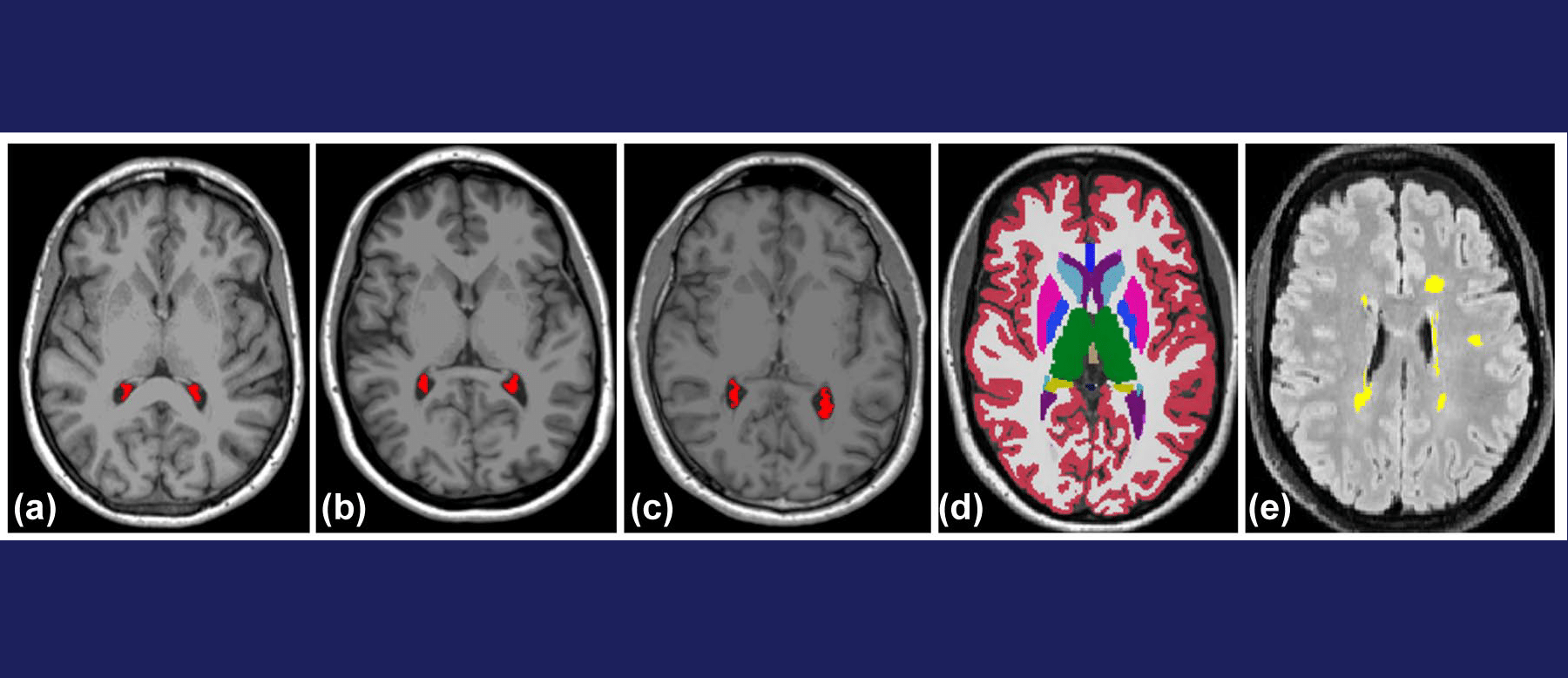Choroid Plexus Enlargement Correlates with Demyelinating Lesions and Thalamic Atrophy in Radiologically Isolated Syndrome