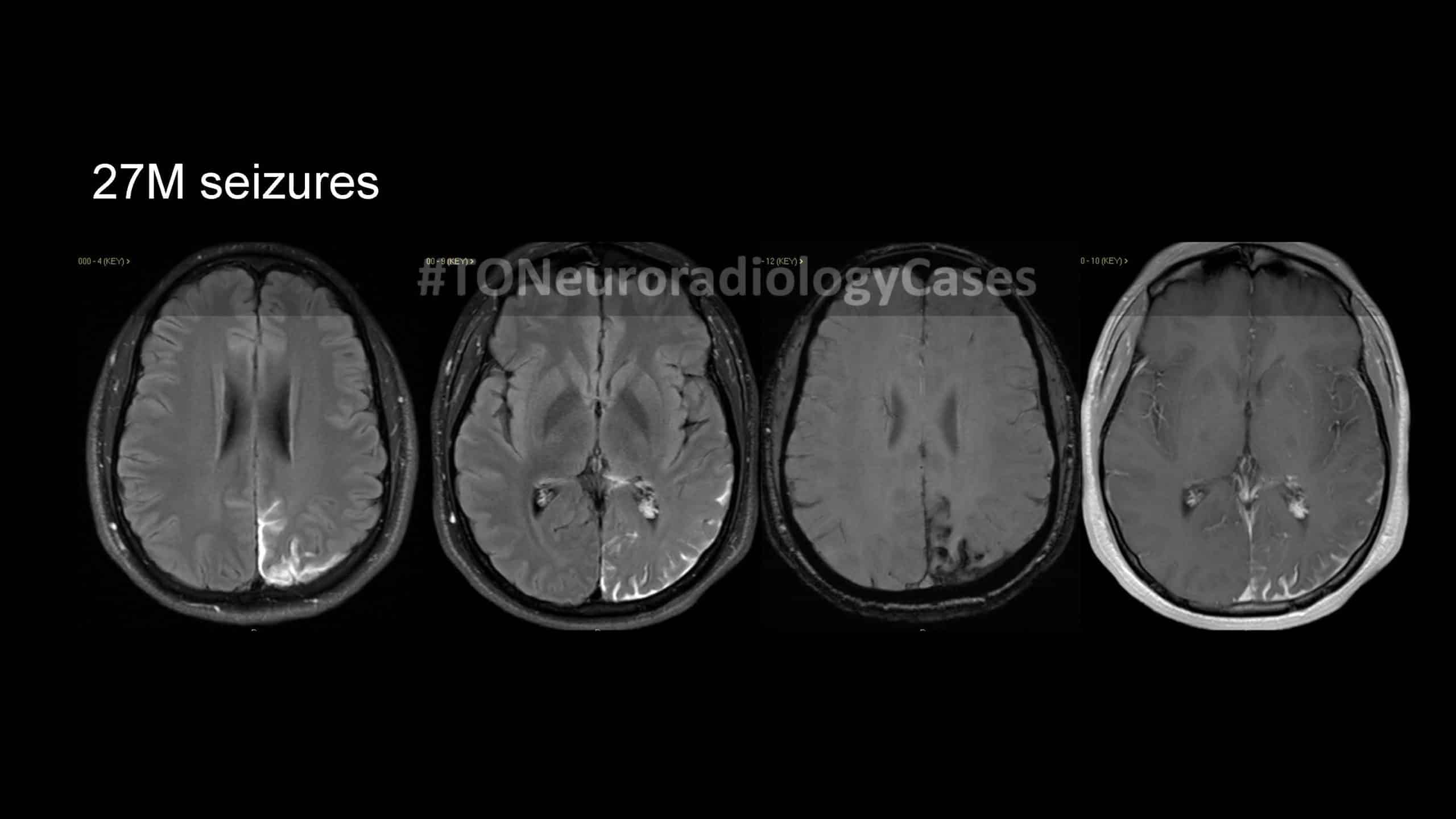Neuroradiology Case of the Week: Week 44
