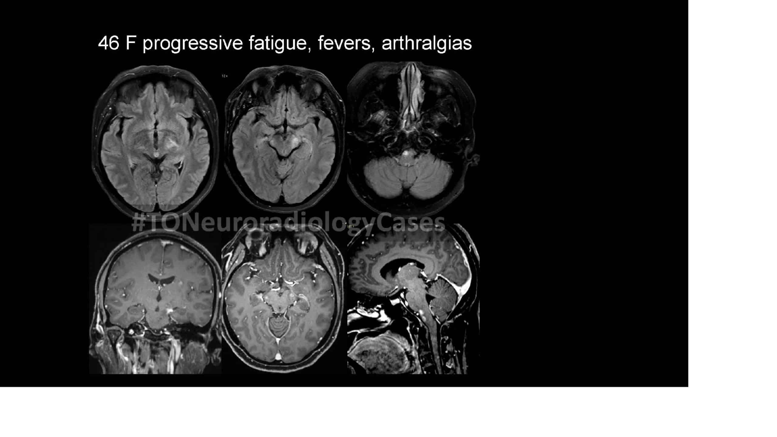 Neuroradiology Case of the Week: Week 45