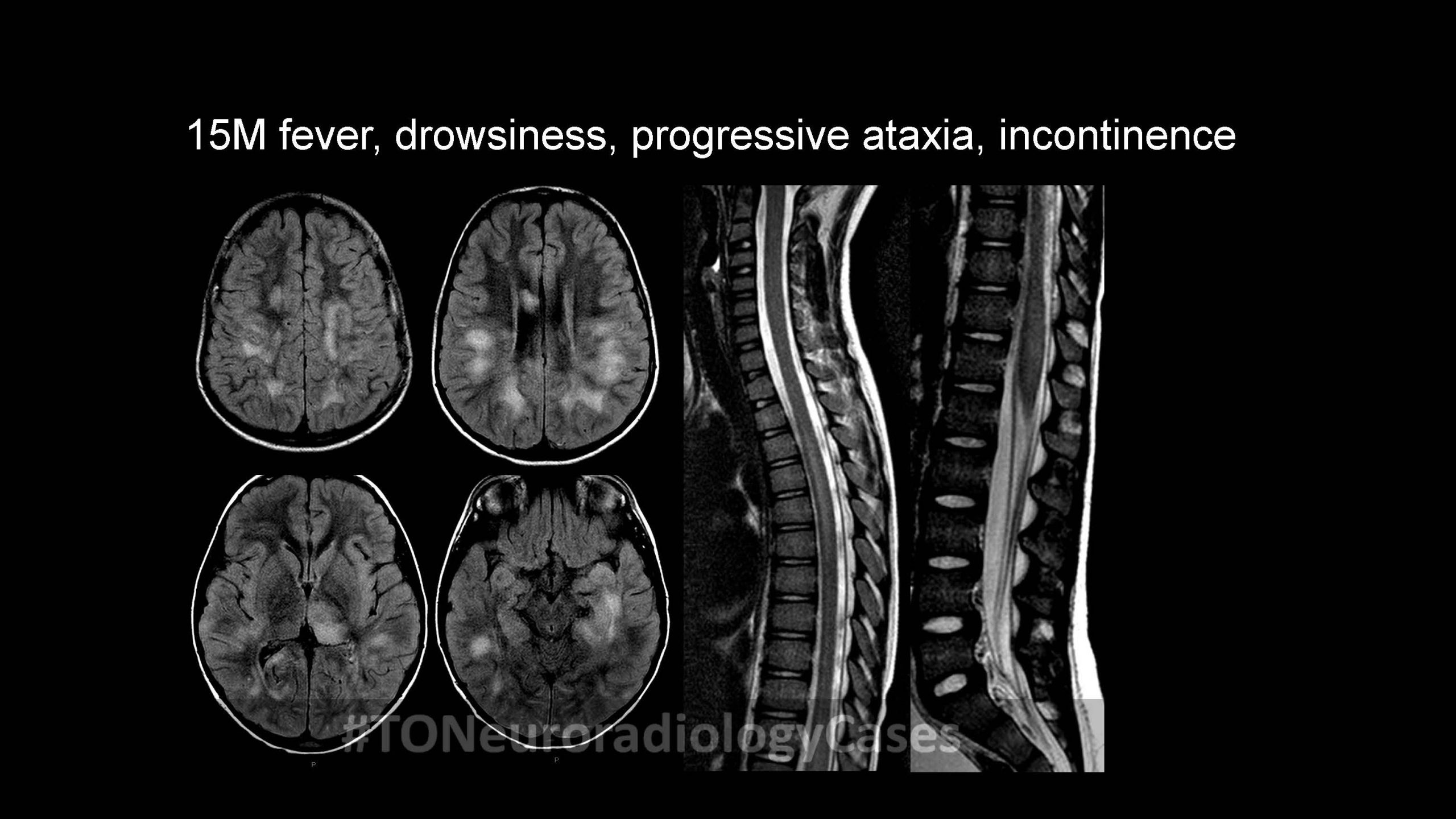 Neuroradiology Case of the Week: Week 46