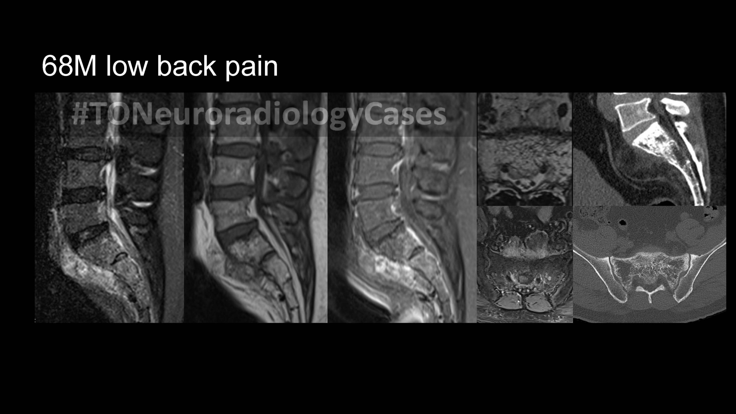 Neuroradiology Case of the Week: Week 47