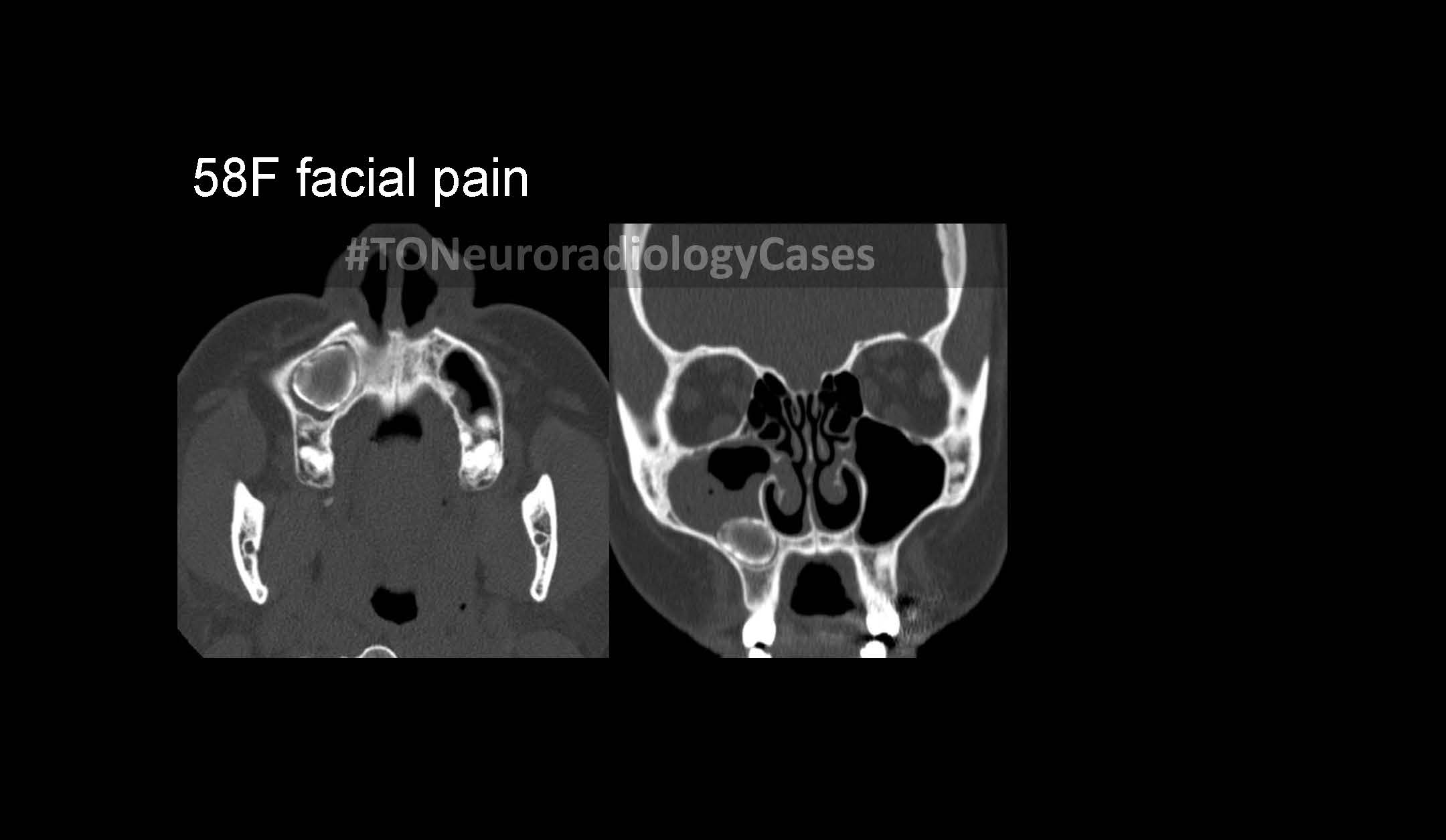 Neuroradiology Case of the Week: Week 48