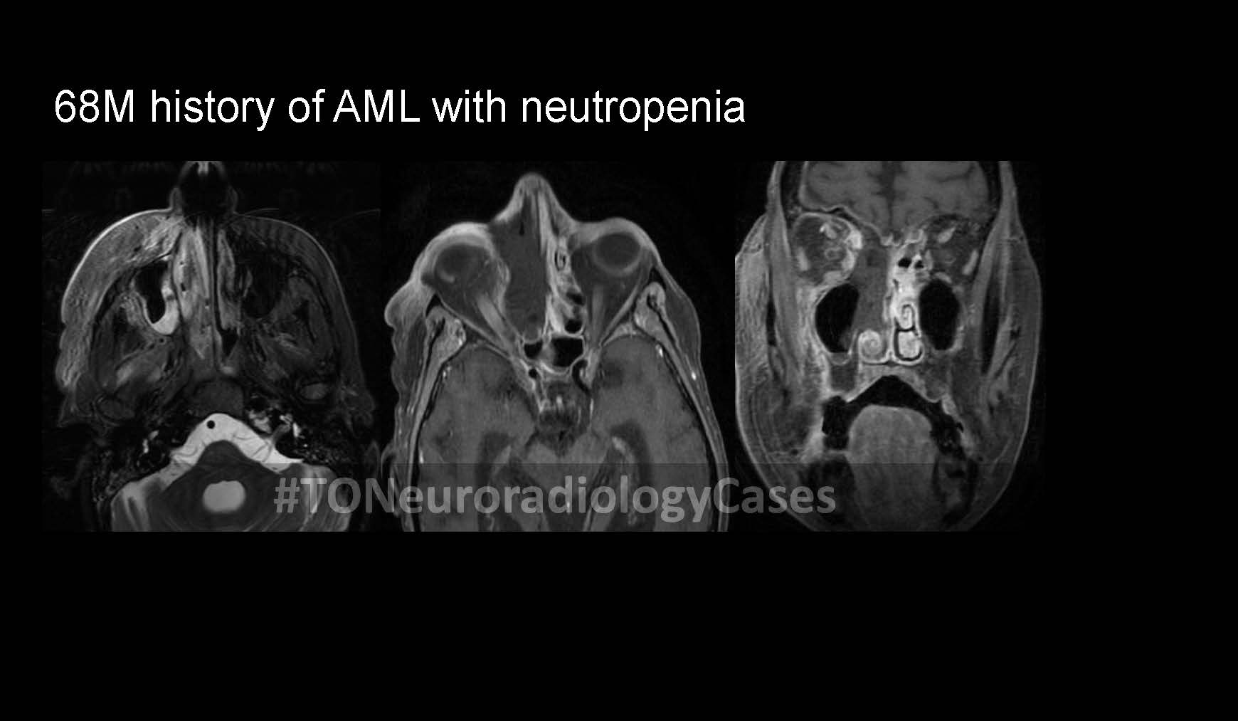 Neuroradiology Case of the Week: Week 50