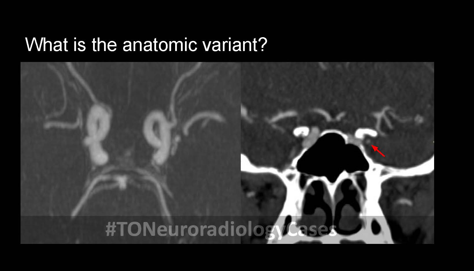 Neuroradiology Case of the Week: Week 51
