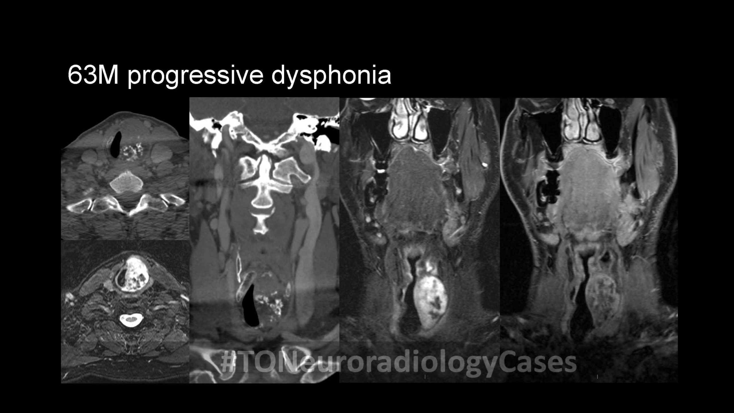 Neuroradiology Case of the Week: Week 52