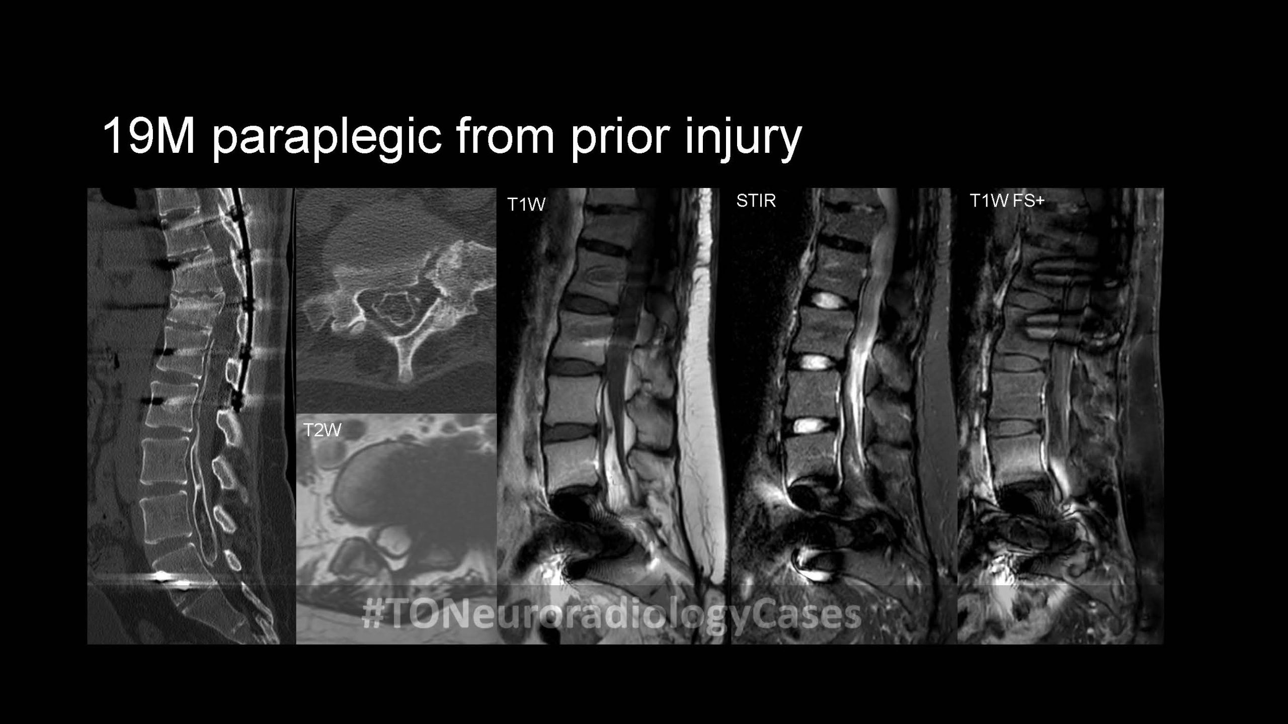 Neuroradiology Case of the Week: Week 53