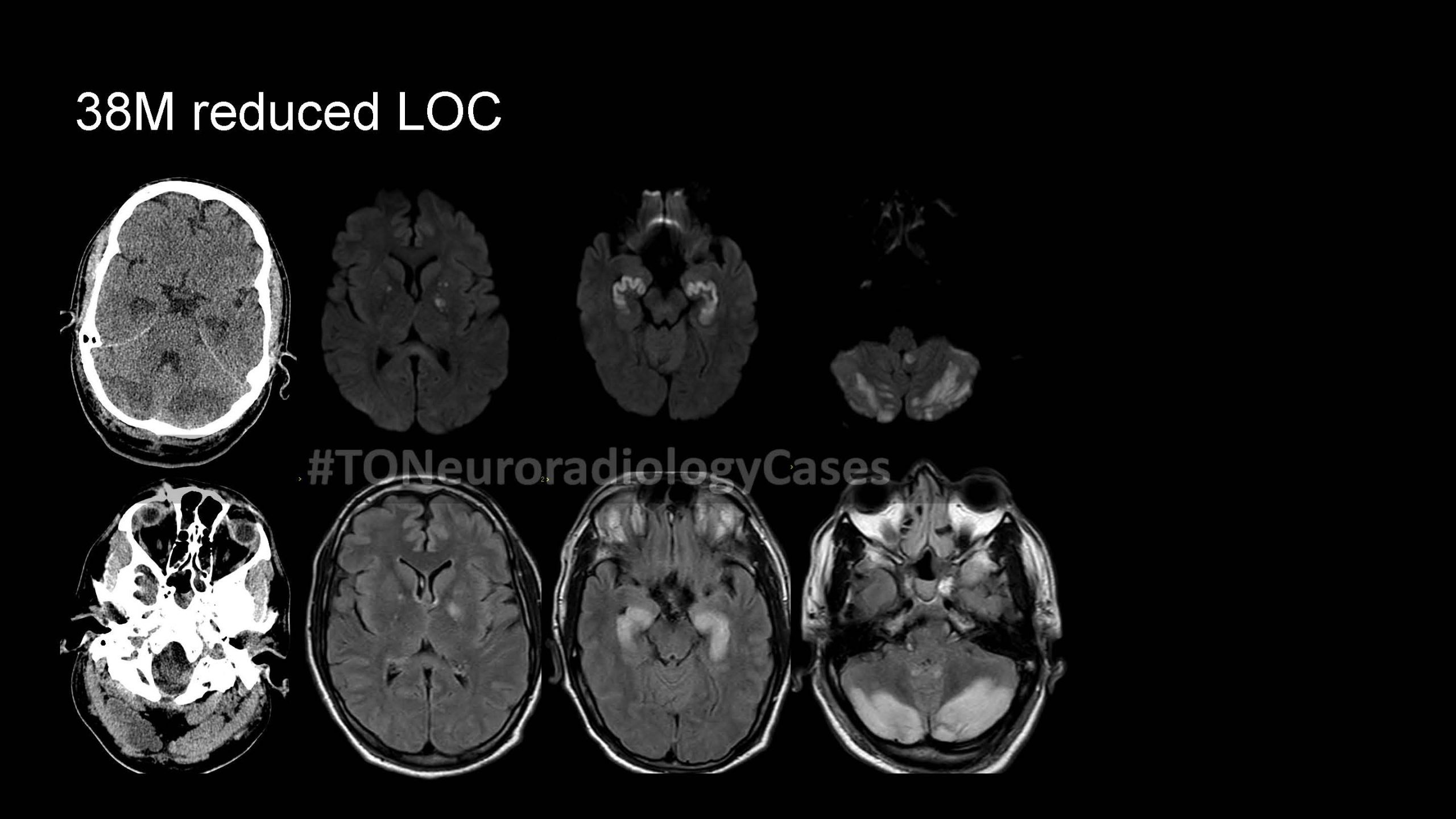 Neuroradiology Case of the Week: Week 54