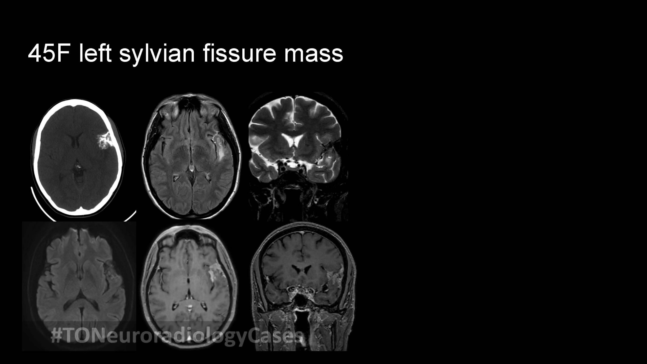 Neuroradiology Case of the Week: Week 55