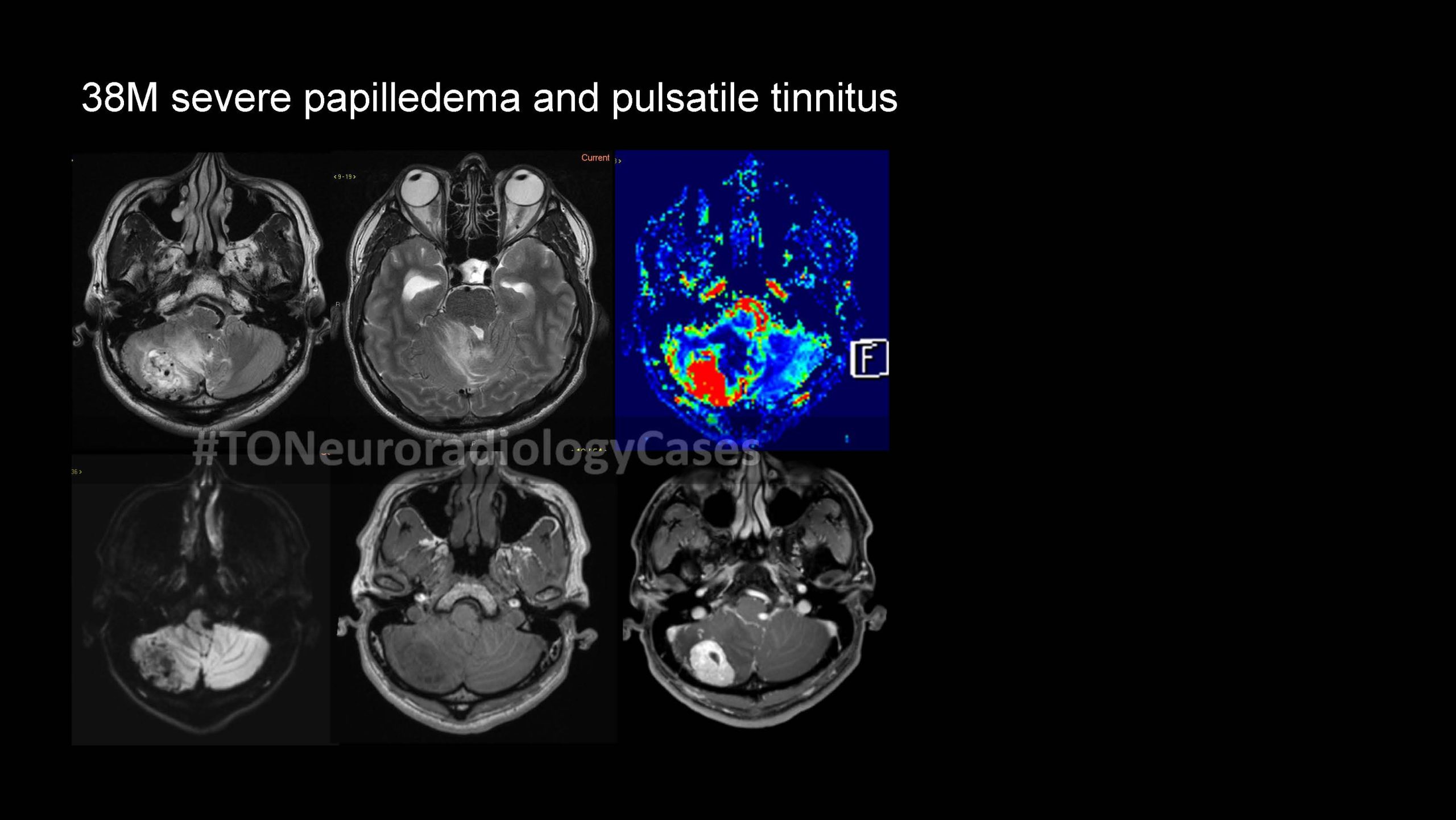 Neuroradiology Case of the Week: Week 56