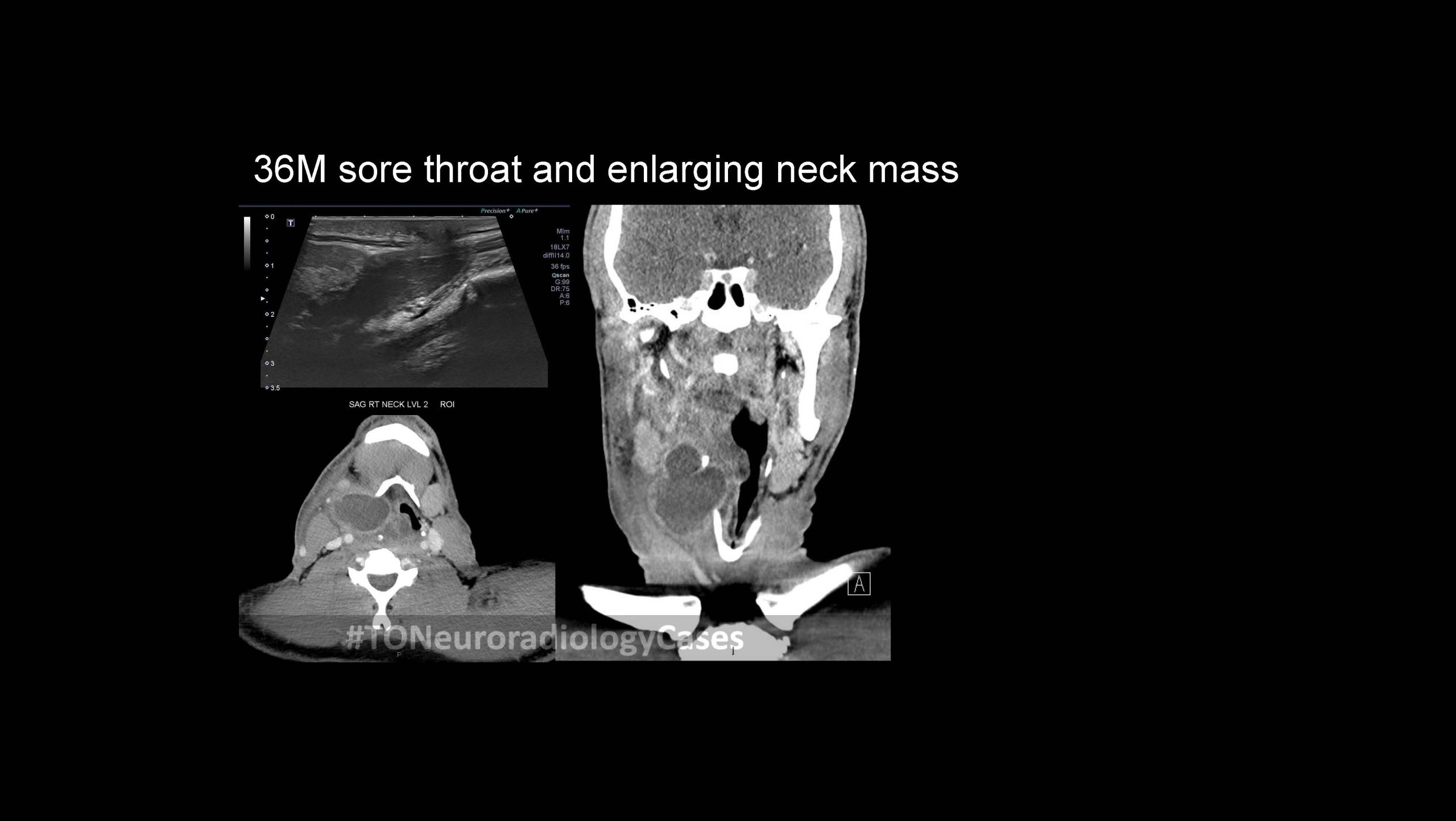 Neuroradiology Case of the Week: Week 57