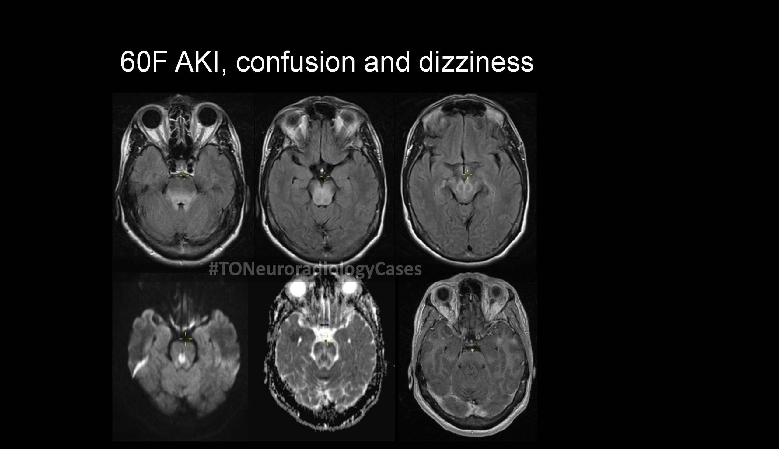 Neuroradiology Case of the Week: Week 58