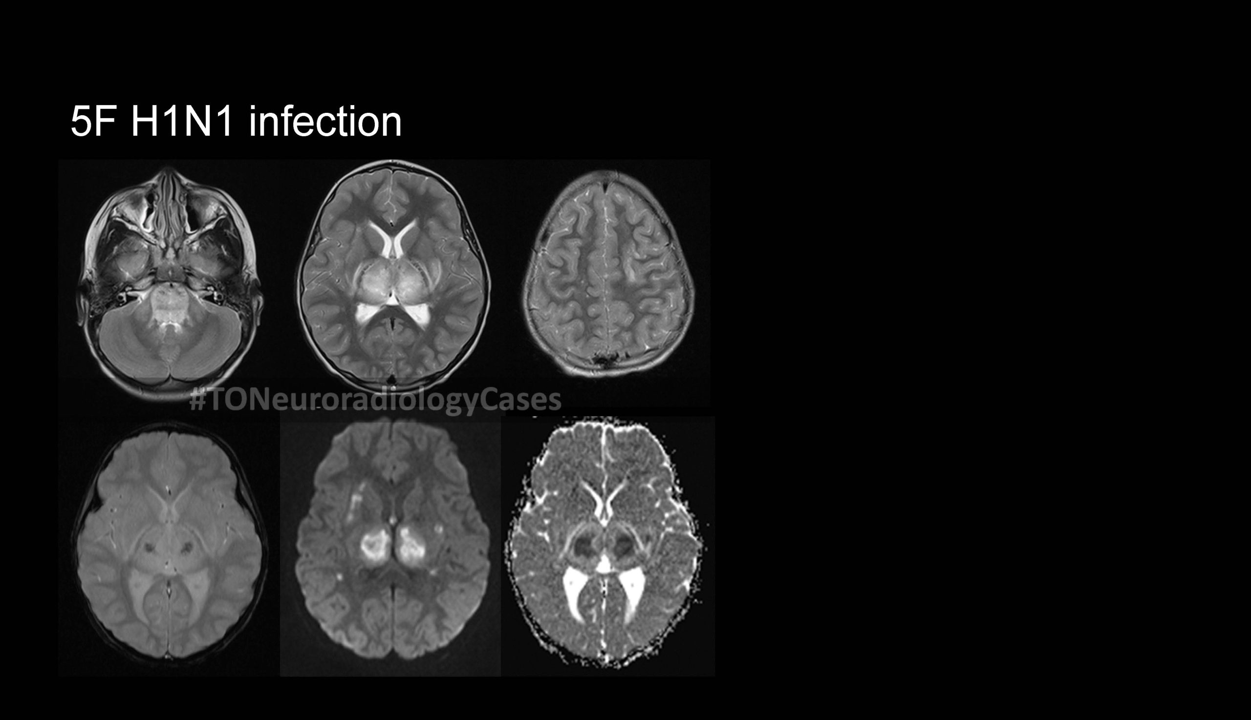 Neuroradiology Case of the Week: Week 59