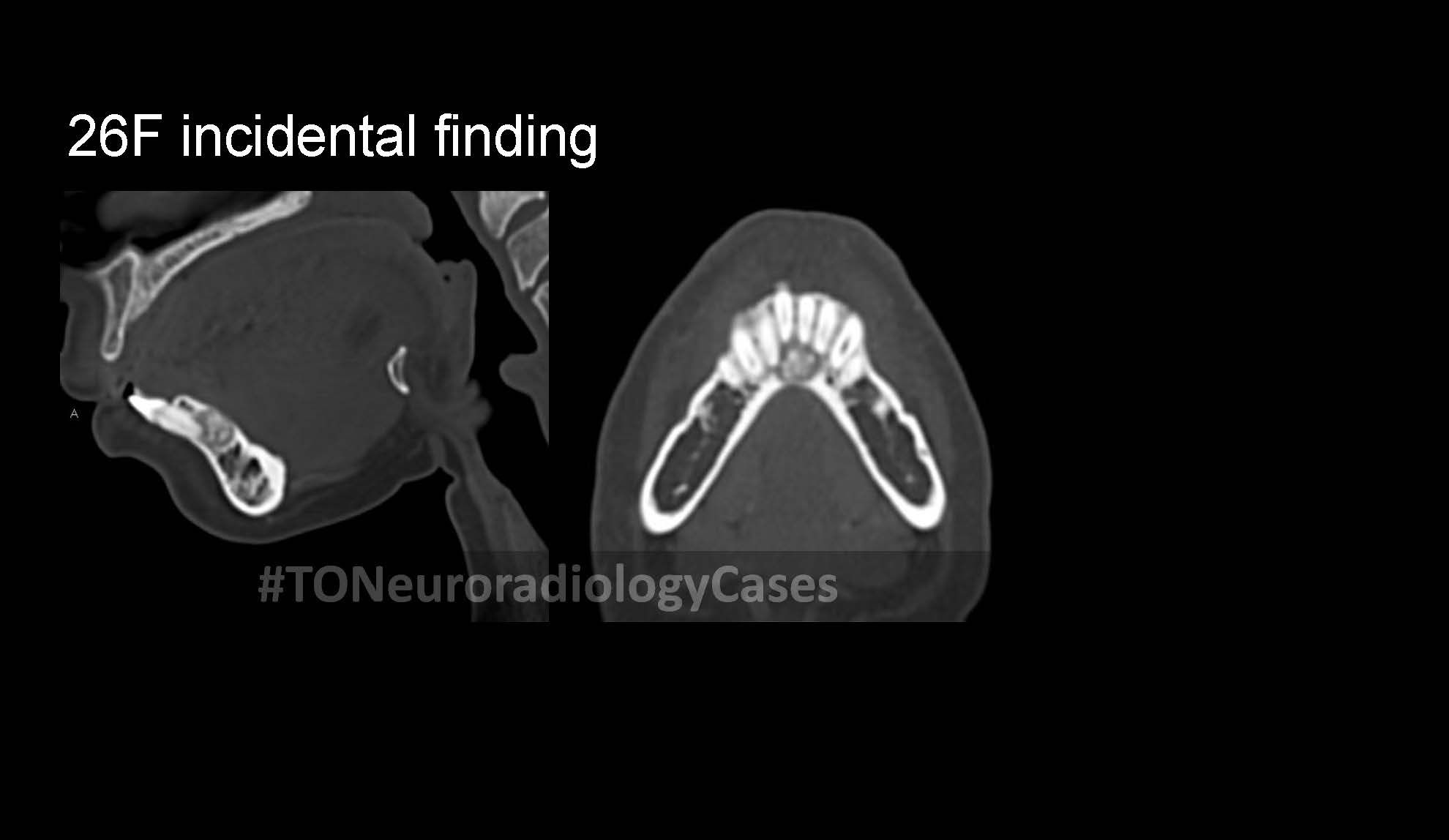 Neuroradiology Case of the Week: Week 60