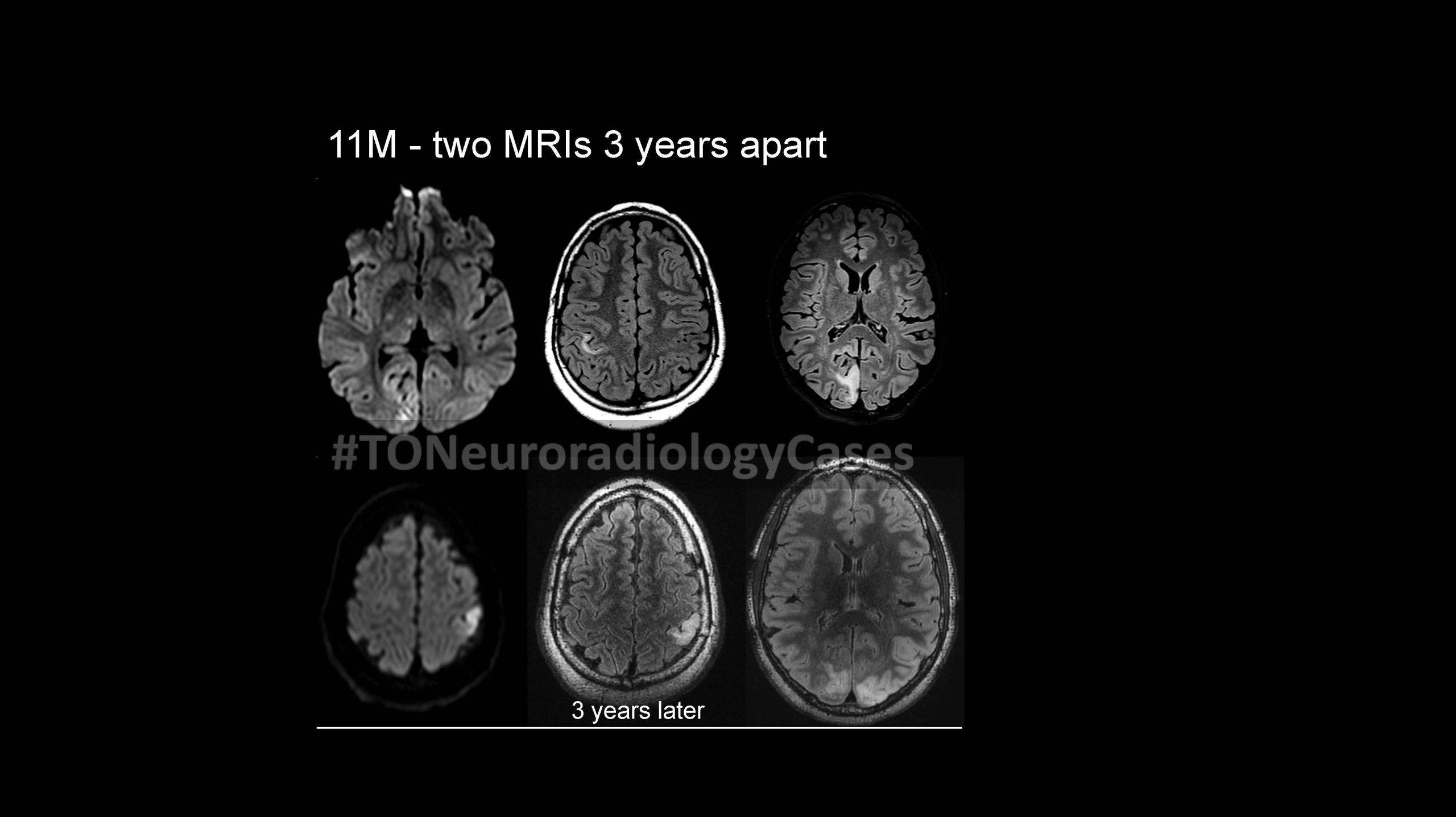 Neuroradiology Case of the Week: Week 61
