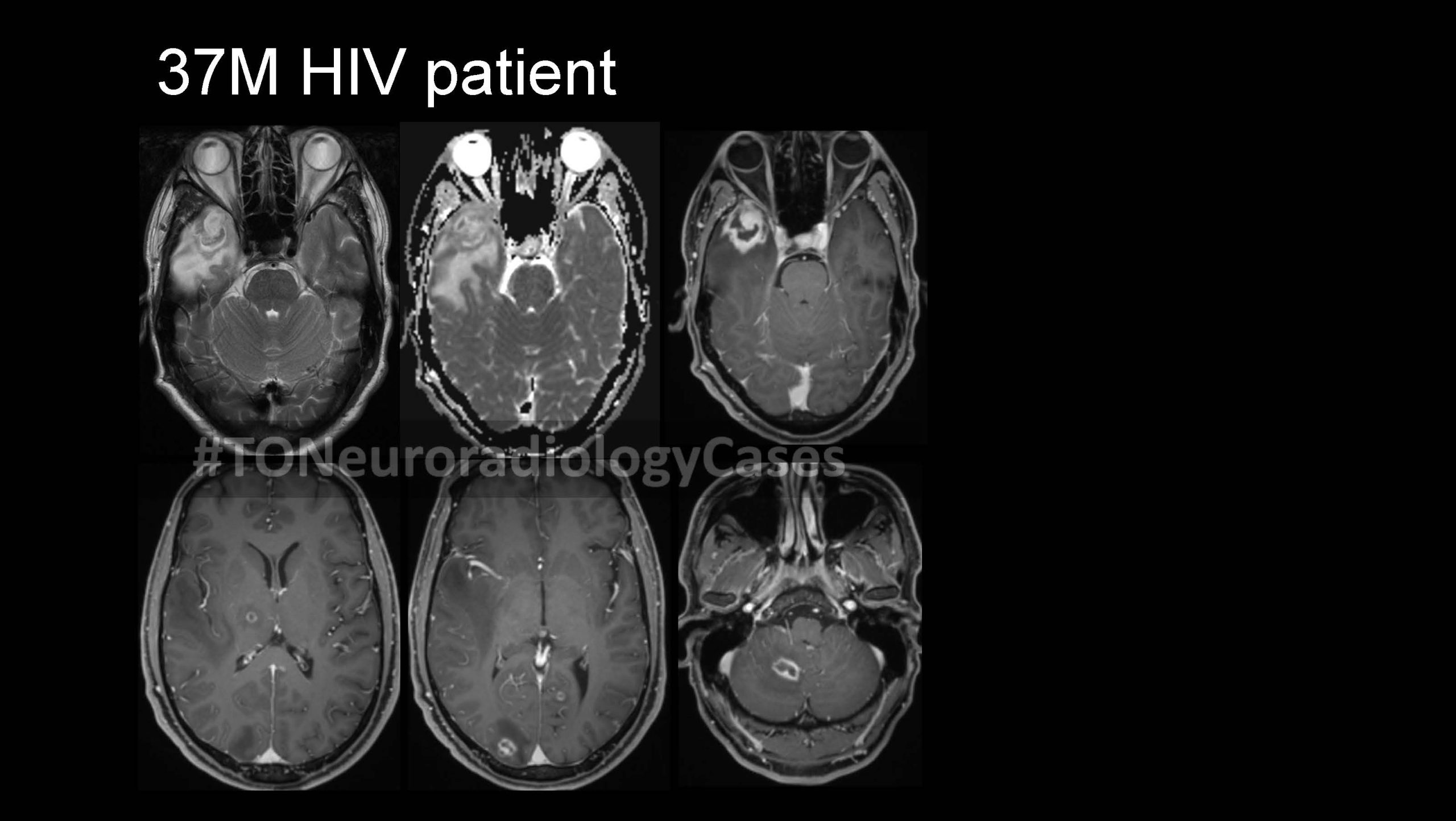 Neuroradiology Case of the Week: Week 62