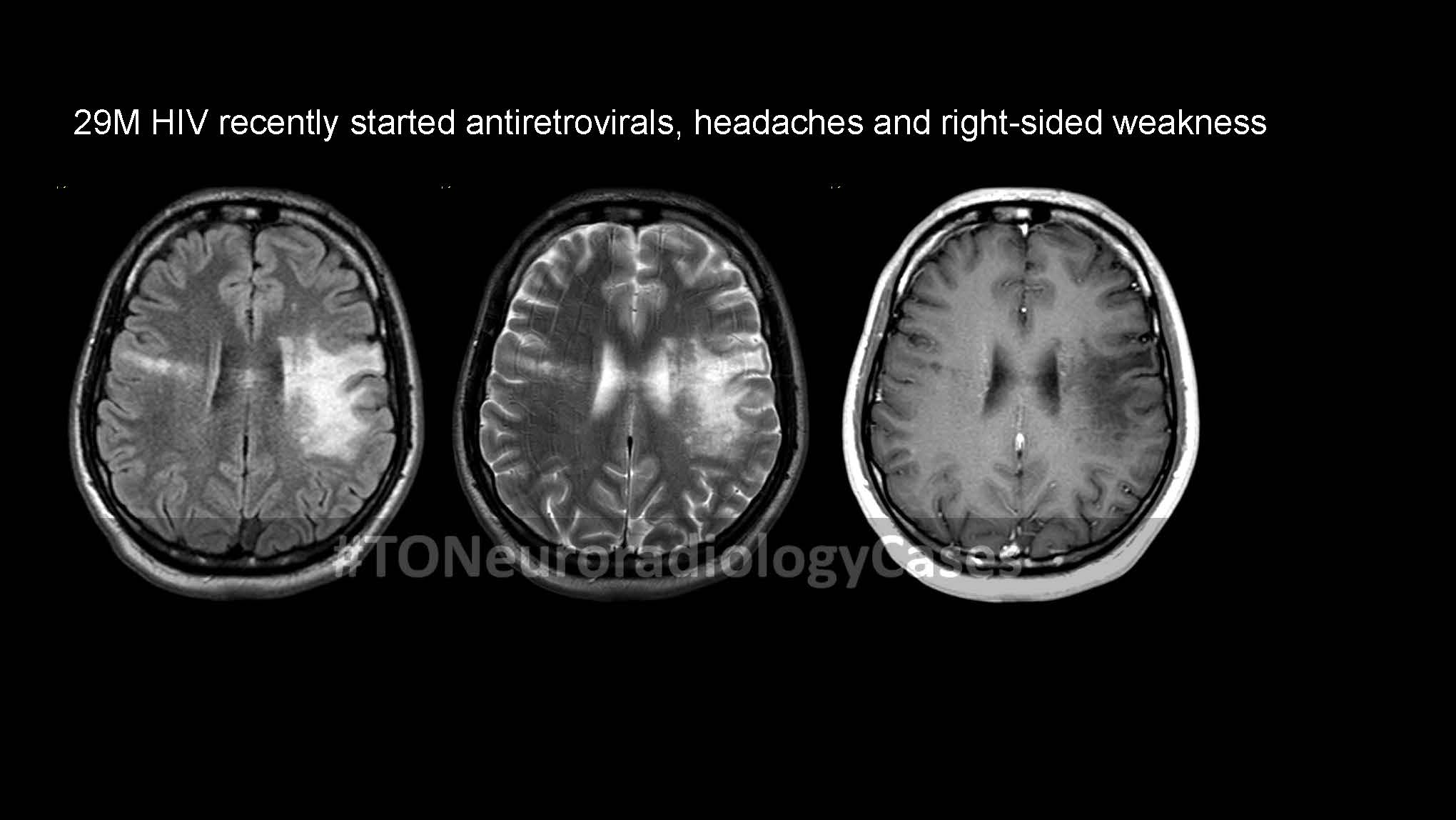 Neuroradiology Case of the Week: Week 63