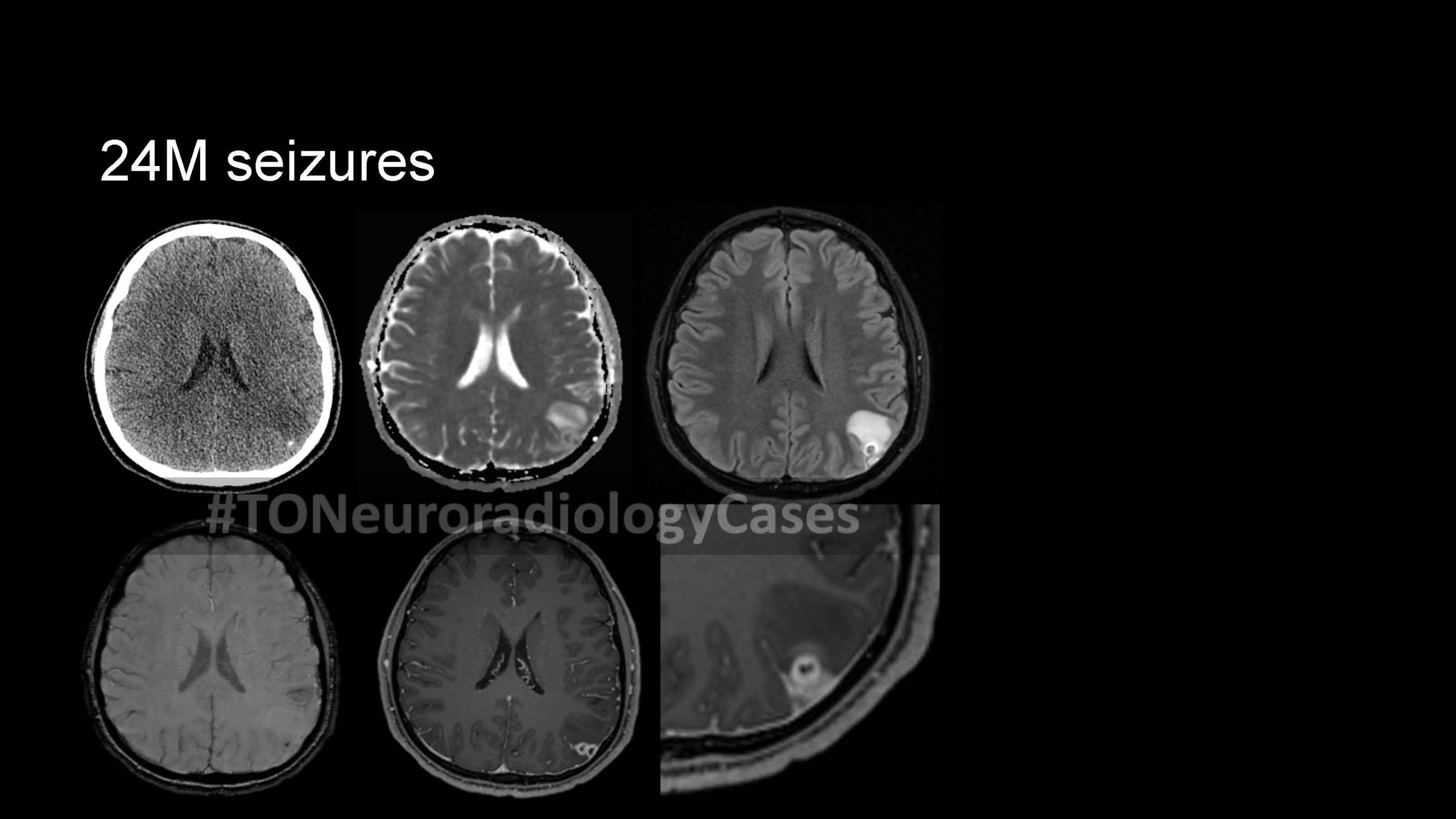 Neuroradiology Case of the Week: Week 64