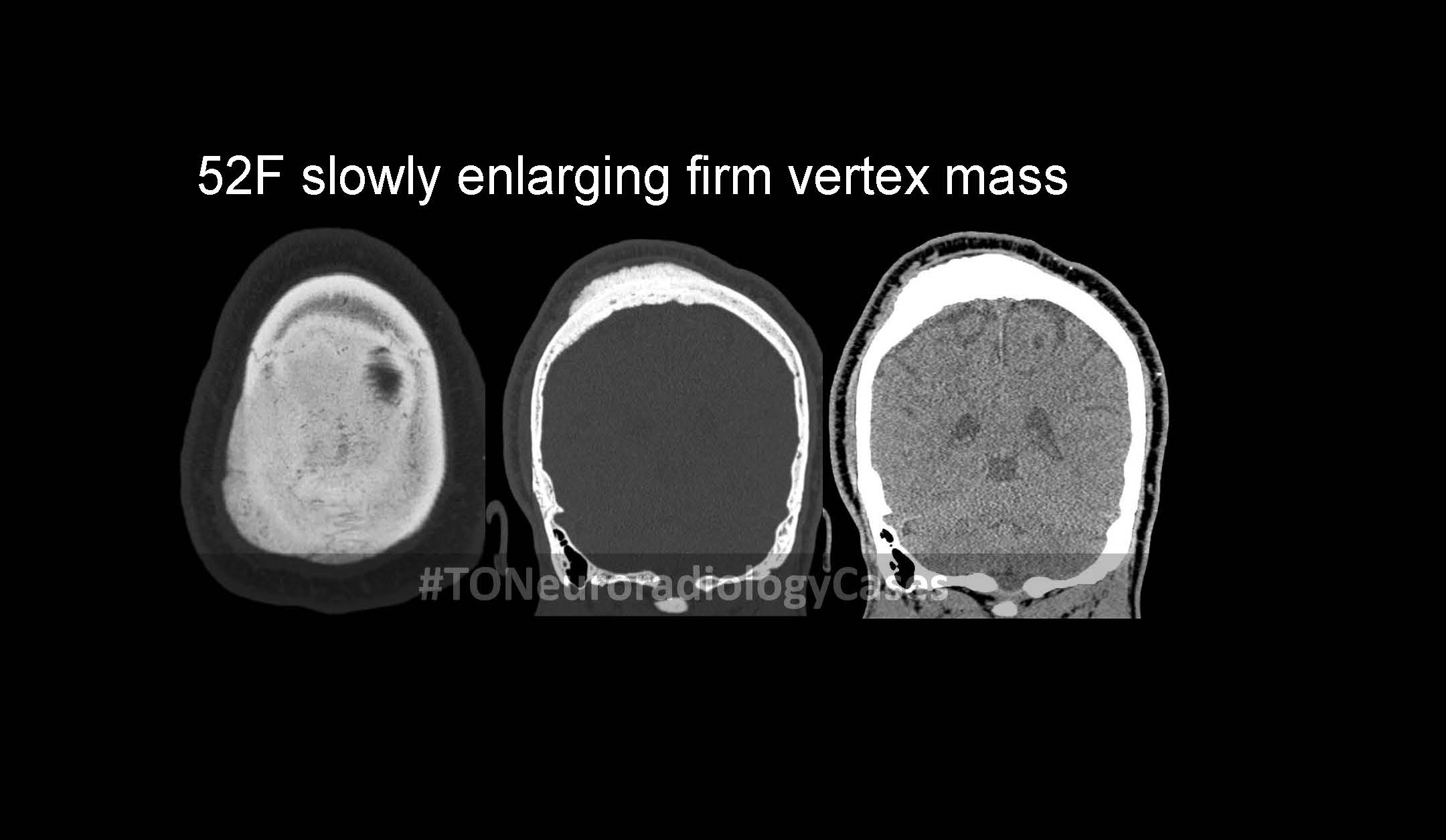 Neuroradiology Case of the Week: Week 65