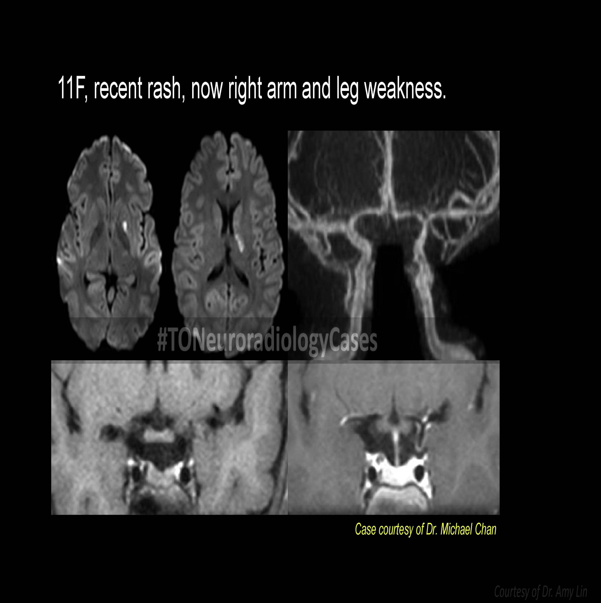 Neuroradiology Case of the Week: Week 66
