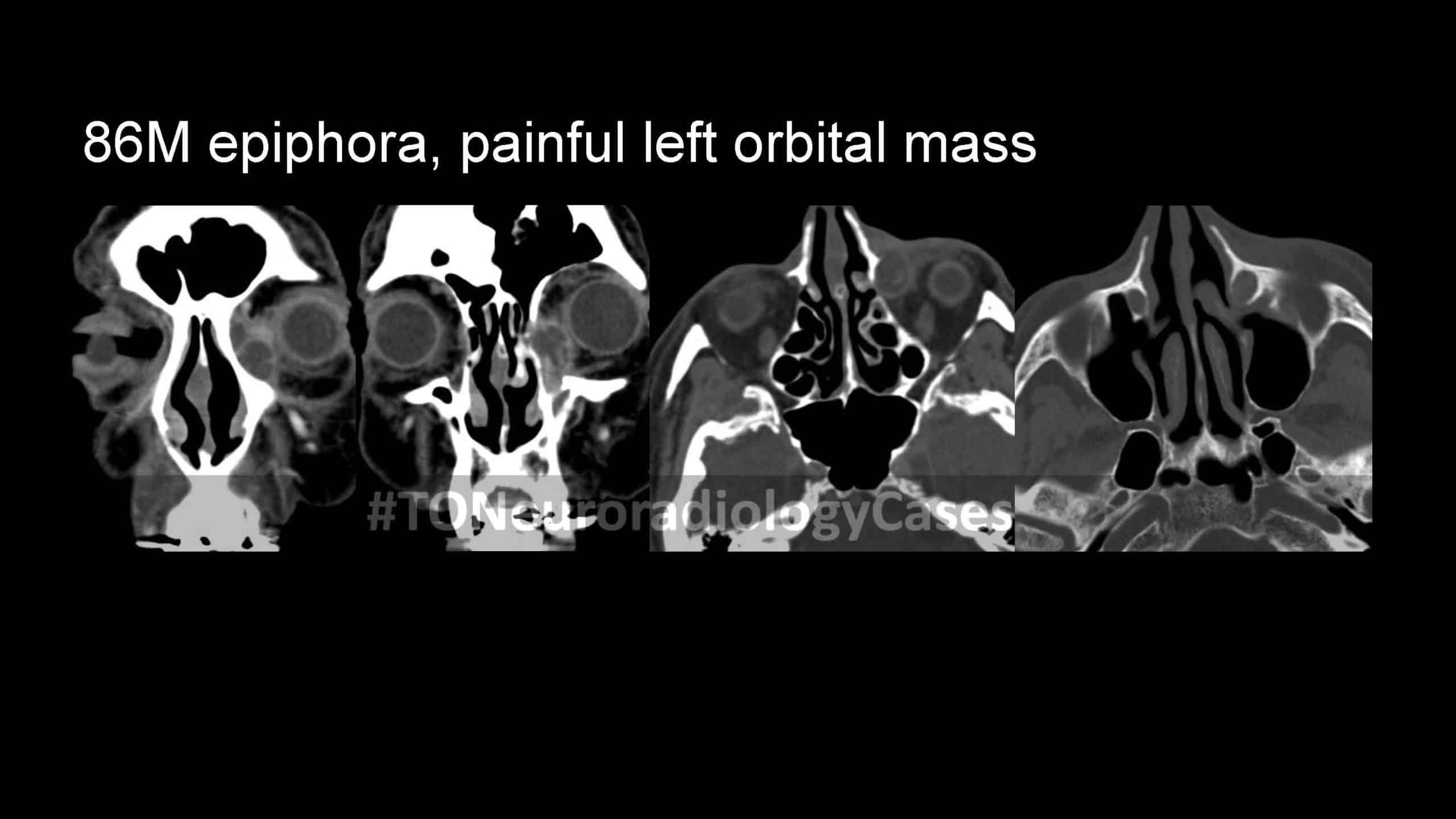 Neuroradiology Case of the Week: Week 67
