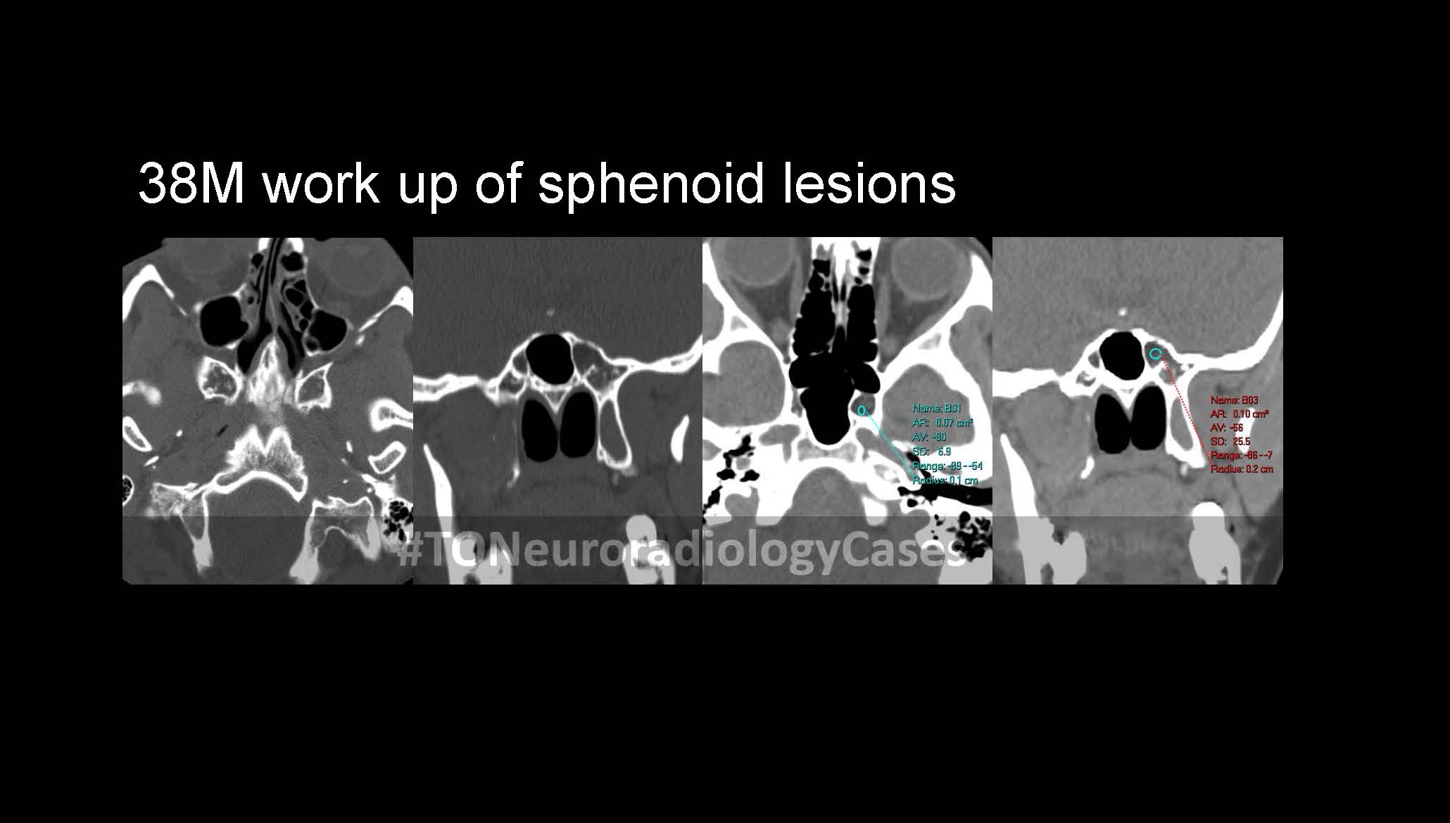 Neuroradiology Case of the Week: Week 68