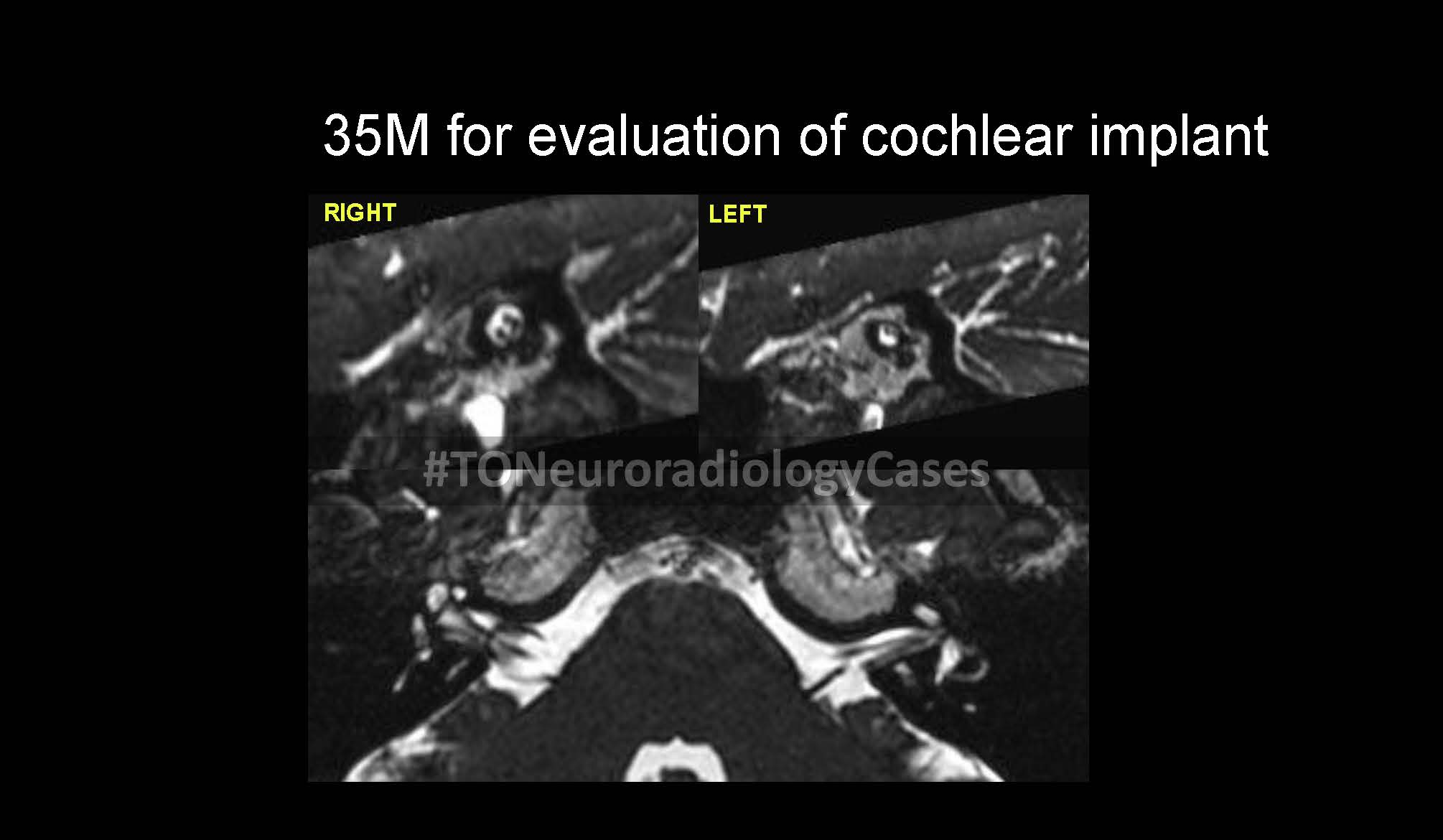 Neuroradiology Case of the Week: Week 69