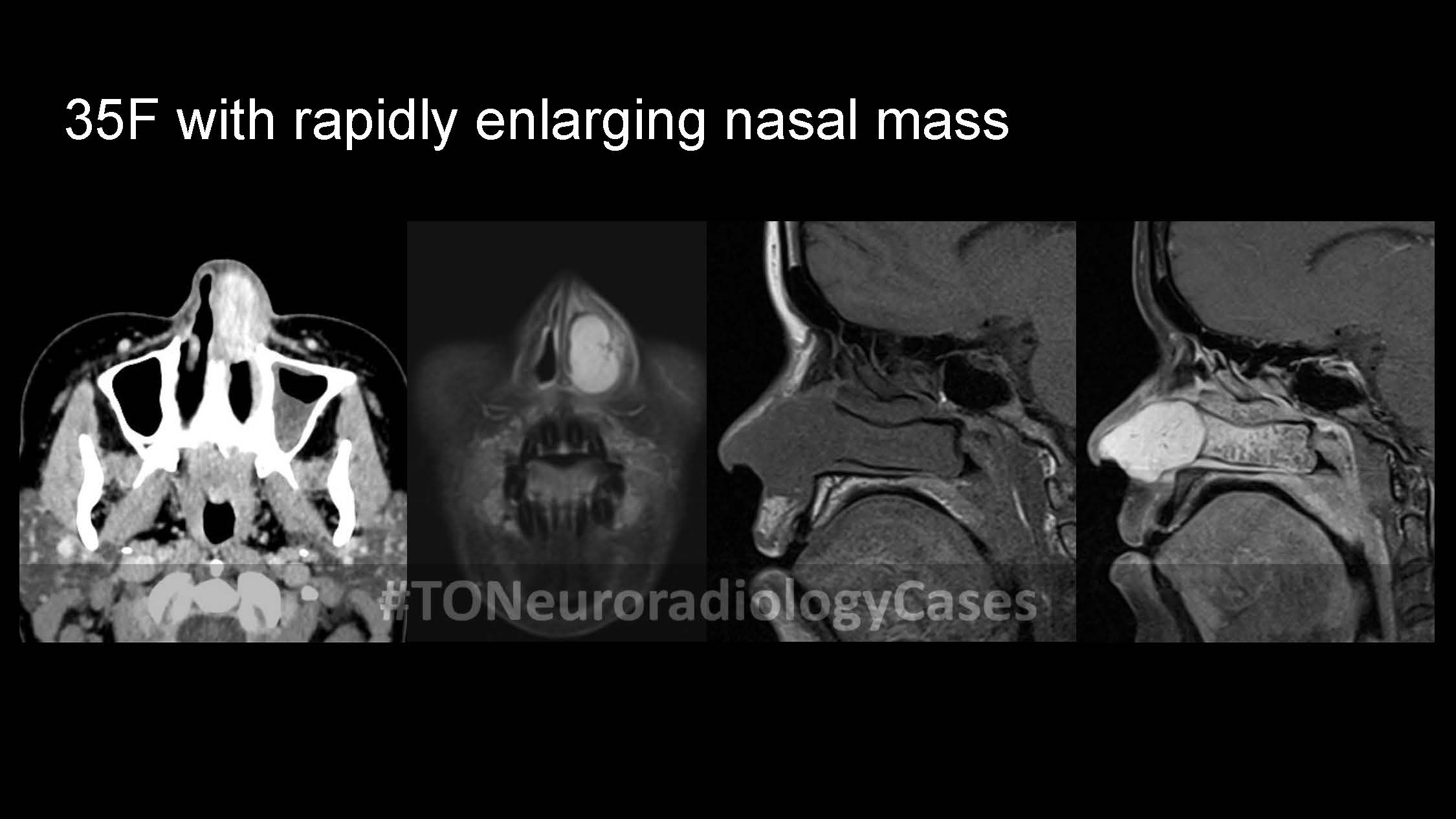 Neuroradiology Case of the Week: Week 70