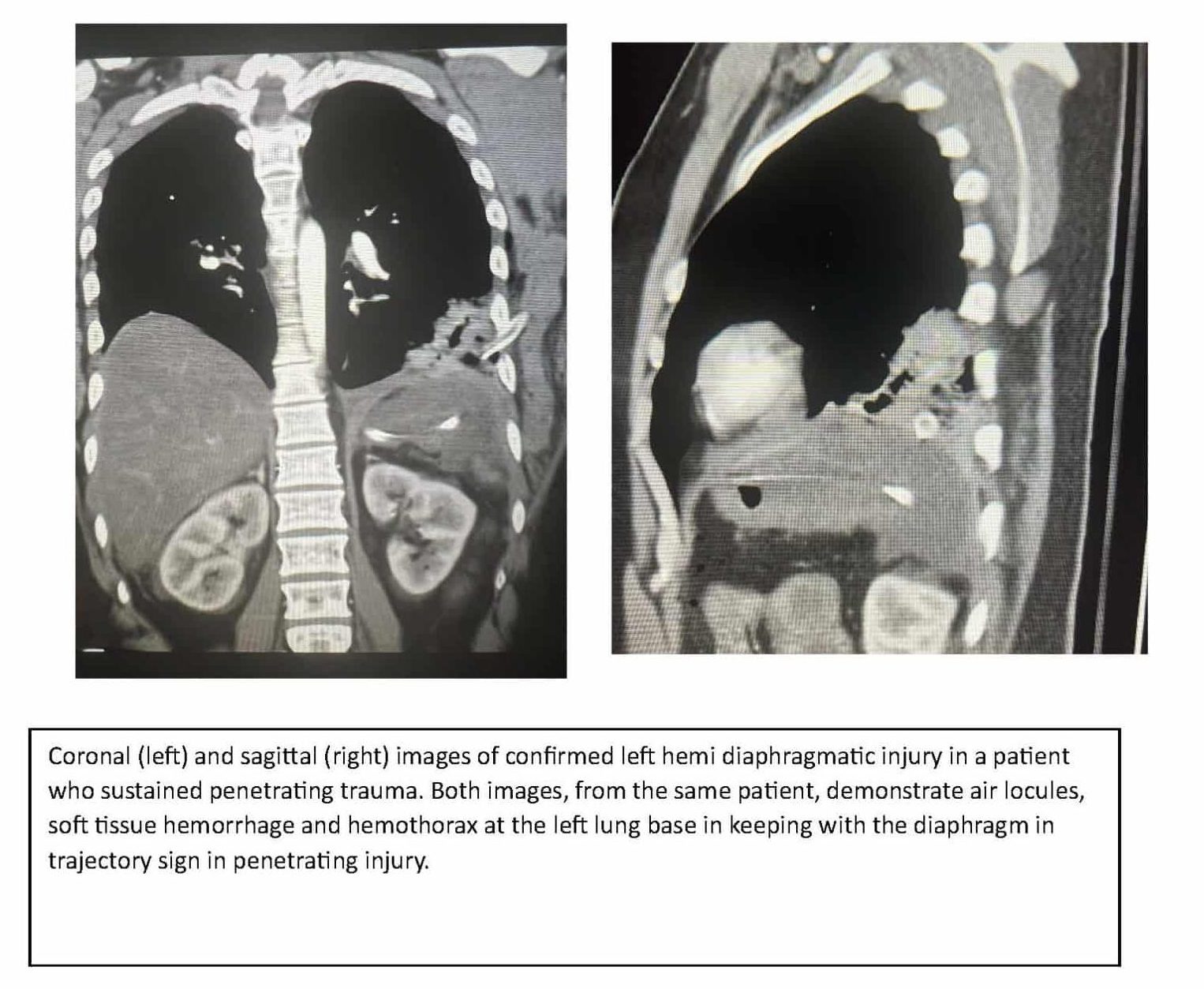 CT Evaluation of Traumatic Diaphragmatic Injury: a Large Retrospective Cohort Study of Blunt and Penetrating Trauma 2 CT Evaluation of Traumatic Diaphragmatic Injury: a Large Retrospective Cohort Study of Blunt and Penetrating Trauma